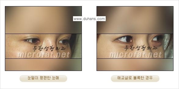 [두한성형외과 경쟁력 눈밑성형] - [타 병원 필러 애교살 시술 부작용을 미세지방이식으로 교정] 관련 이미지 5