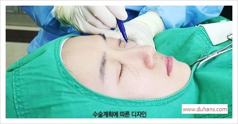 [두한성형외과 경쟁력 눈밑성형] - [눈밑 미세지방이식의 이해도 안내] 관련 이미지 3