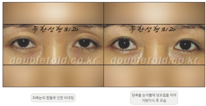 [두한성형외과 쌍커플재수술] - [비대칭 쌍커풀 라인] 관련 이미지 21