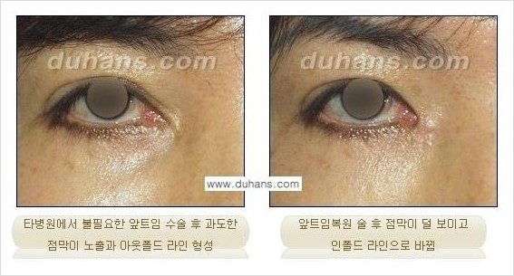 [두한성형외과 경쟁력 눈성형] - [앞트임 복원수술, 뒤트임 수술 안내] 관련 이미지 4