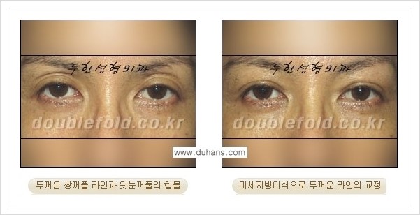 [두한성형외과 경쟁력 눈성형] - [미세지방이식으로 두껍고 어색한 라인 교정 안내 1.] 관련 이미지 6
