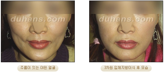 [두한성형외과 얼굴자가지방이식] - [볼살, 이마, 측두부] 관련 이미지 11