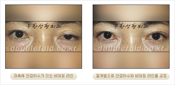 [두한성형외과 경쟁력 눈성형] - [안검하수(졸리운 눈매) 교정 방법 안내] 관련 이미지 17