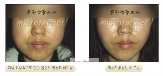 [두한성형외과 경쟁력 지방이식] - [두한 자가지방이식 클리닉 안내]​ 관련 이미지 91
