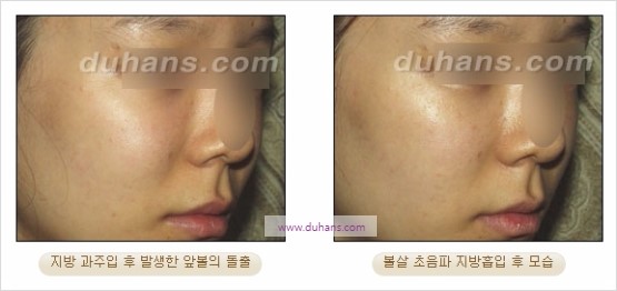 [두한성형외과 경쟁력 지방흡입] - [볼살, 턱선의 간편 지방흡입] 관련 이미지 13