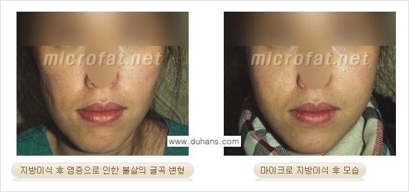 [두한성형외과 경쟁력 미세지방이식] - [미세지방이식 부작용 종류와 교정방법 안내] 관련 이미지 5
