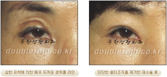 쌍꺼풀수술 두한성형외과 - 쌍커풀재수술의 문제점 관련 이미지 4