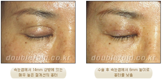 쌍꺼풀수술 두한성형외과 - 쌍커풀재수술의 문제점 관련 이미지 2