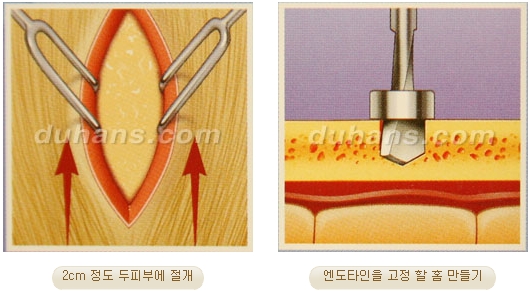 두한성형외과 안티에이징 리프팅 - 엔도타인 리프팅 관련 이미지 21