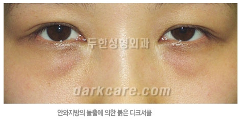 [두한성형외과 다크서클 수술방법] - [NO흉터 눈밑지방제거] 관련 이미지 2