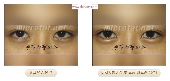 ​﻿[두한성형외과 경쟁력 지방이식] - [눈밑 애교살 시술을 위한 미세지방이식] 관련 이미지 30