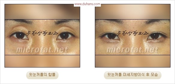 [두한성형외과 경쟁력 눈성형 리더] - [윗눈꺼풀 함몰( #꺼진눈꺼풀) 미세지방이식과 상안검성형]#꺼진눈성형 , #눈위함몰 관련 이미지 30