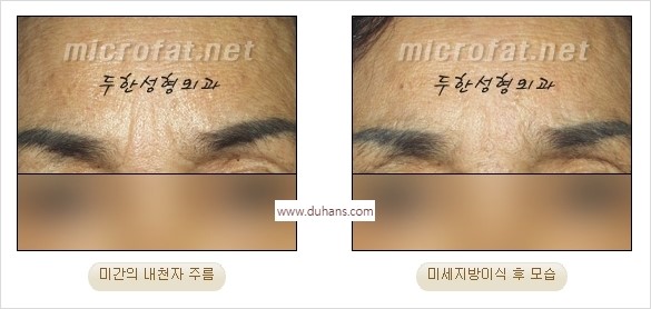 [두한성형외과 경쟁력 동안성형 리더] - ​[미간주름, 이마주름, 안검성형, 이마거상술, 눈썹거상술] 관련 이미지 17