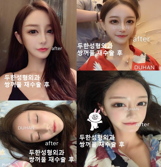 [두한성형외과] - [쌍꺼풀재수술, 눈밑혈관] 관련 이미지 4