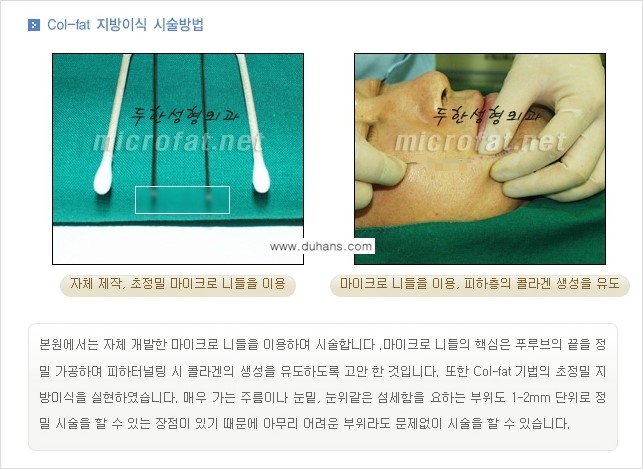 [두한성형외과 상표특허 "Col-fat(콜펫) 지방이식"] - [Col-fat(콜펫) 지방이식이란?] 관련 이미지 5