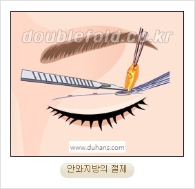 [두한성형외과 경쟁력 눈성형] - [자연스럽고 아름다운 눈매를 만드는 여러 가지 눈성형 방법] 관련 이미지 9