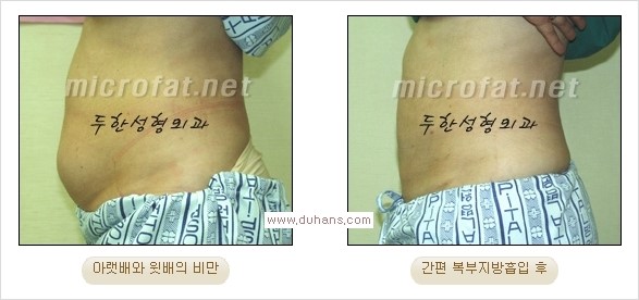 [두한성형외과 경쟁력 지방흡입] - [초음파 지방흡입과 미세흡입관을 이용한 간편지방흡입] 관련 이미지 11