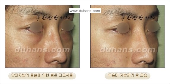 [두한성형외과 젊은 눈매 안검성형] - [눈밑 지방제거의 수술 전후 안내 ②] 관련 이미지 11