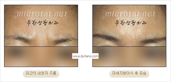 [두한성형외과 경쟁력 동안성형 리더] - ​[미간주름, 이마주름, 안검성형, 이마거상술, 눈썹거상술] 관련 이미지 16