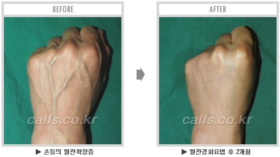 [종아리성형 두한성형외과] - [종아리수술에 대한 자주하는 질문과 답변 모음] 관련 이미지 44