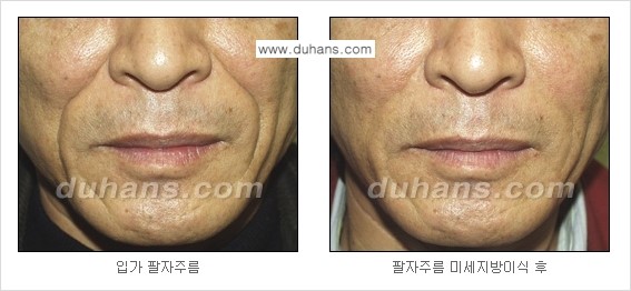 [두한성형외과 경쟁력 주름성형] - [미세지방이식을 이용한 주름교정 안내 - 눈밑주름, 입가주름, 팔자주름 2.] 관련 이미지 20