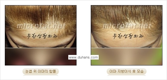 [두한성형외과의 경쟁력 있는 지방이식] - [이마 미세지방이식 2.] 관련 이미지 14