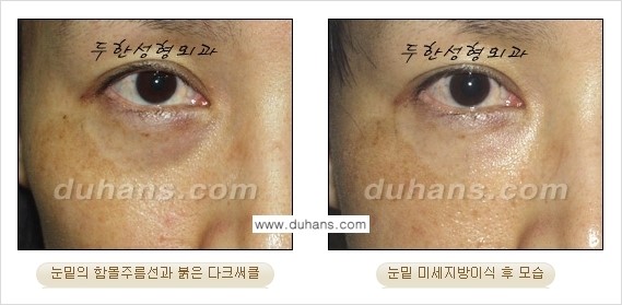 [두한성형외과 상큼하고 환한 눈매완성] - [눈밑 미세지방이식 ②] 관련 이미지 6