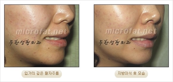 [두한성형외과 경쟁력 안티에이징 동안성형] - [주름이 깊은 푹~ 꺼진 입가 팔자주름 안녕!] 관련 이미지 26