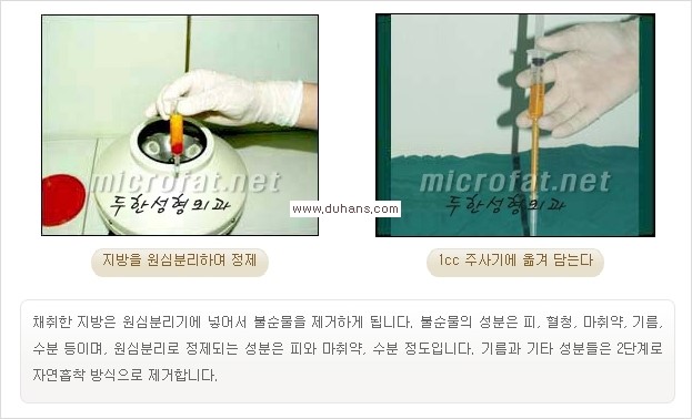 [두한성형외과 경쟁력 눈밑성형] - [눈밑 애교살 - 이상적인 눈밑 미세지방이식 방법] 관련 이미지 5