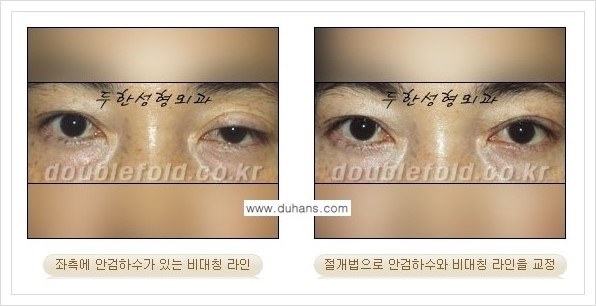 [두한성형외과 경쟁력 쌍꺼풀 재수술, 극한 재수술] - [안검하수(졸린눈매) 교정 방법 안내] 관련 이미지 10