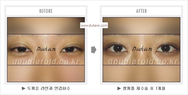 [두한성형외과 경쟁력 눈성형] - [나에게 맞는 어울리는 쌍꺼풀 라인] 관련 이미지 24