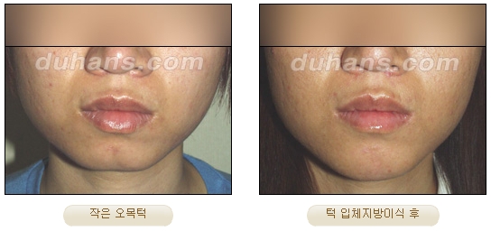 [Duhan Plastic Surgery Facial Autologous Fat Grafting] - [Fat Grafting Guide] image 13
