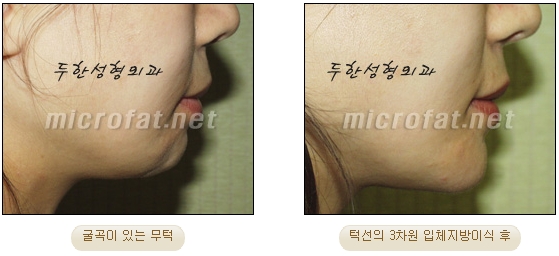 [두한성형외과 미세지방이식] - [무턱교정 안내] 관련 이미지 27