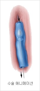 [두한성형외과 경쟁력 정맥류 치료] - [정맥류와 정맥확장증 치료] 관련 이미지 4