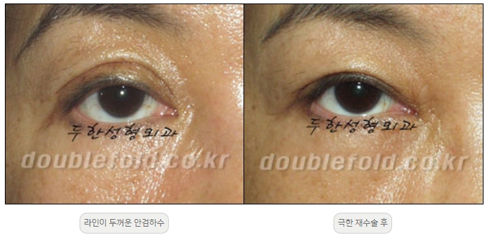 [Double Eyelid Surgery, Duhan Plastic Surgery] - [Extreme Revision Eye Surgery to Correct a Damaged Line] image 11