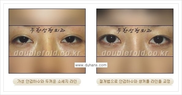 [두한성형외과 경쟁력 쌍꺼풀 재수술, 극한 재수술] - [안검하수(졸린눈매) 교정 방법 안내] 관련 이미지 3