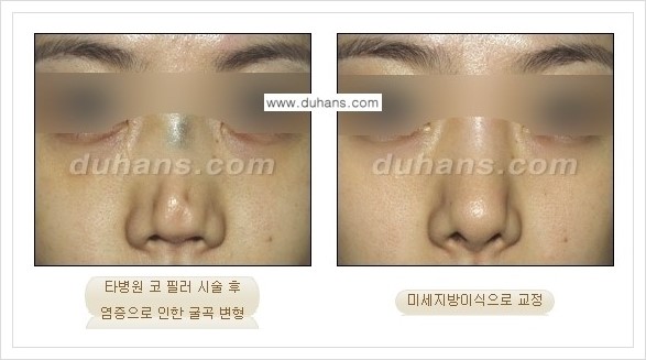[두한성형외과 경쟁력 코성형] - [미세지방이식 코성형 안내] 관련 이미지 7