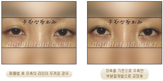 [두한성형외과 눈재수술] - [부분절개법 재수술] 관련 이미지 41
