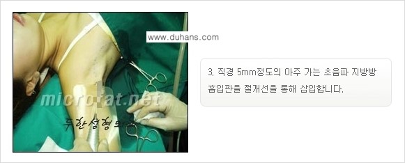 [두한성형외과 경쟁력 액취증, 다한증 치료] - [겨드랑이의 참기 힘든 냄새와 땀 치료 - 초음파 컷터지방흡입 + 리포셋 소파흡입술] 관련 이미지 16