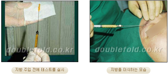 눈성형잘하는곳 두한성형외과 - 겹쌍꺼풀 관련 이미지 32