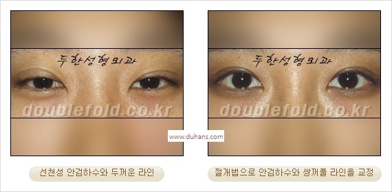 ⁠⁠[두한성형외과 경﻿쟁력 쌍꺼풀 재수술] - [안검하수(졸리운 눈매) 종류와 교정 방법 안내] 관련 이미지 29