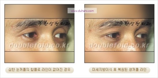 [두한성형외과 경쟁력 눈성형] - [극한 재수술, 함몰된 눈꺼풀 라인교정, 안검하수(졸리운 눈매)] 관련 이미지 67