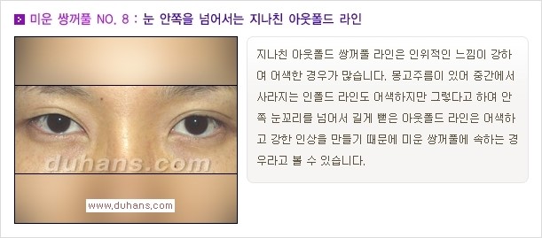 [두한성형외과 경쟁력 쌍꺼풀 재수술, 극한 눈재수술] - [자연스러운 눈매로의 복원 쌍꺼풀 재수술 대상 안내] 관련 이미지 9