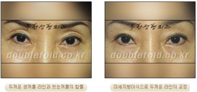[Duhan Plastic Surgery Revision Double Eyelid Surgery] - [Double Eyelid Revision Surgery Process] image 35