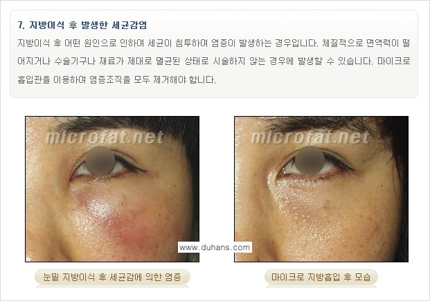 [두한성형외과 "미세지방이식"] - [지방이식 부작용 교정 정보 ③] 관련 이미지 7