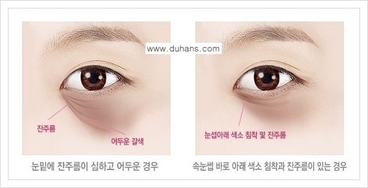 [두한성형외과 경쟁력 다크써클 교정] - [다크써클 5단계로 이뤄지는 핵심 5 STEP SOLUTION 안내 1.] 관련 이미지 5