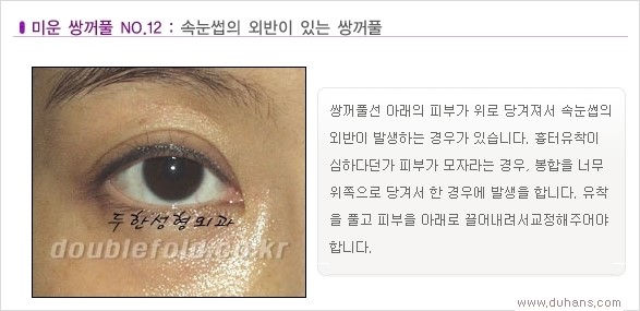 [두한성형외과 경쟁력 쌍꺼풀 재수술, 극한 눈재수술] - [Dr. 컬럼 - 재수술의 목표] 관련 이미지 15