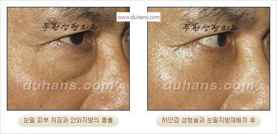 [두한성형외과 경쟁력 안검성형] - [눈밑주름 제거수술] 관련 이미지 12