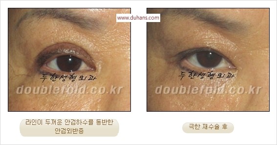 [두한성형외과 경쟁력 쌍꺼풀 재수술] - [두꺼운 라인을 교정하는 극한 재수술(Extreme Rroperation)] 관련 이미지 10
