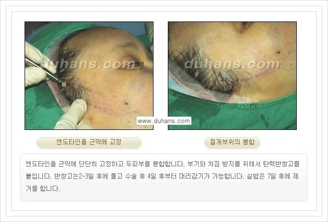 [두한성형외과 경쟁력 주름성형] - [회복과 일상으로의 복귀가 빠른 주름교정 엔도타인 리프팅] 관련 이미지 17